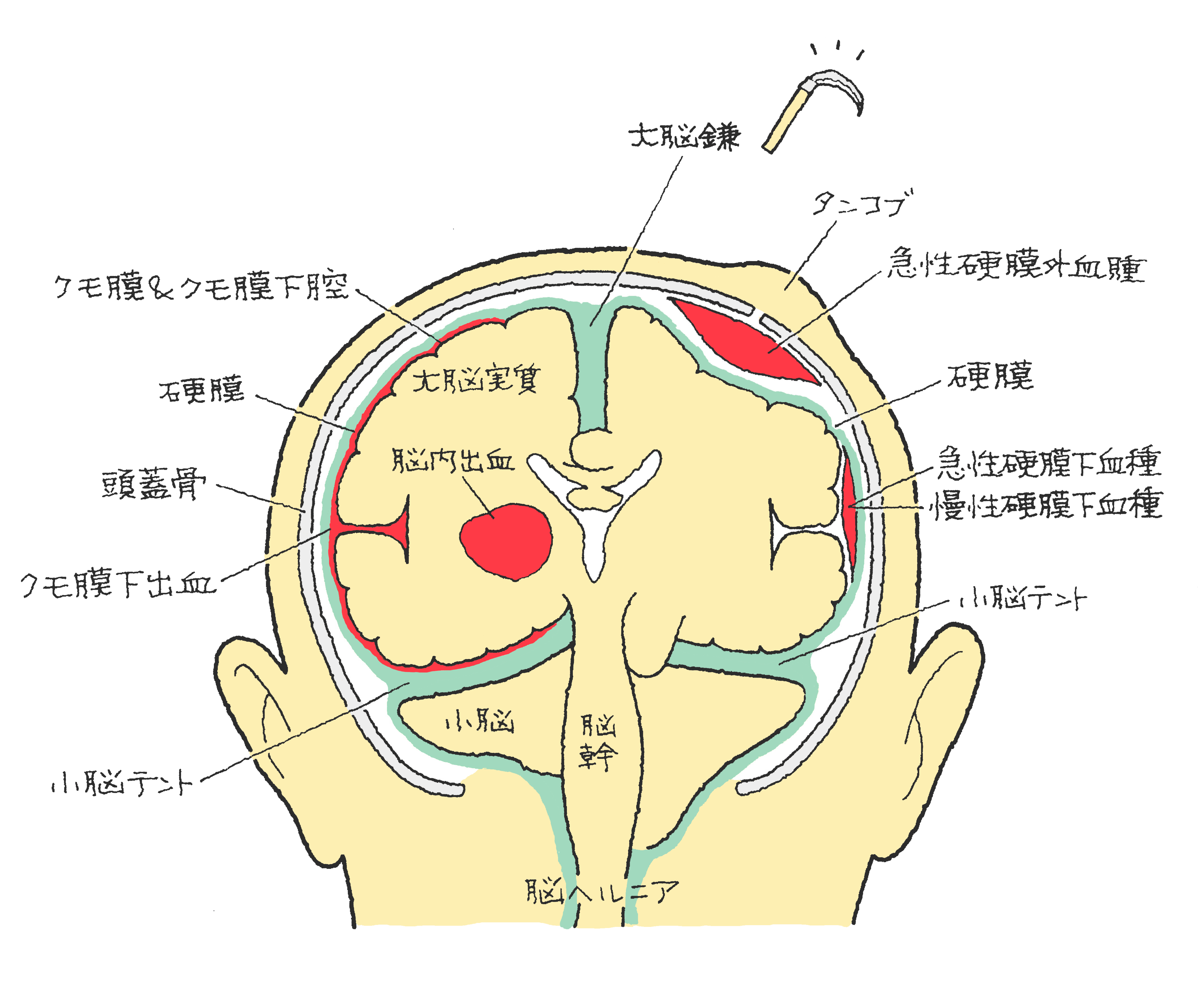 くも膜 下 出血 家族 に できること