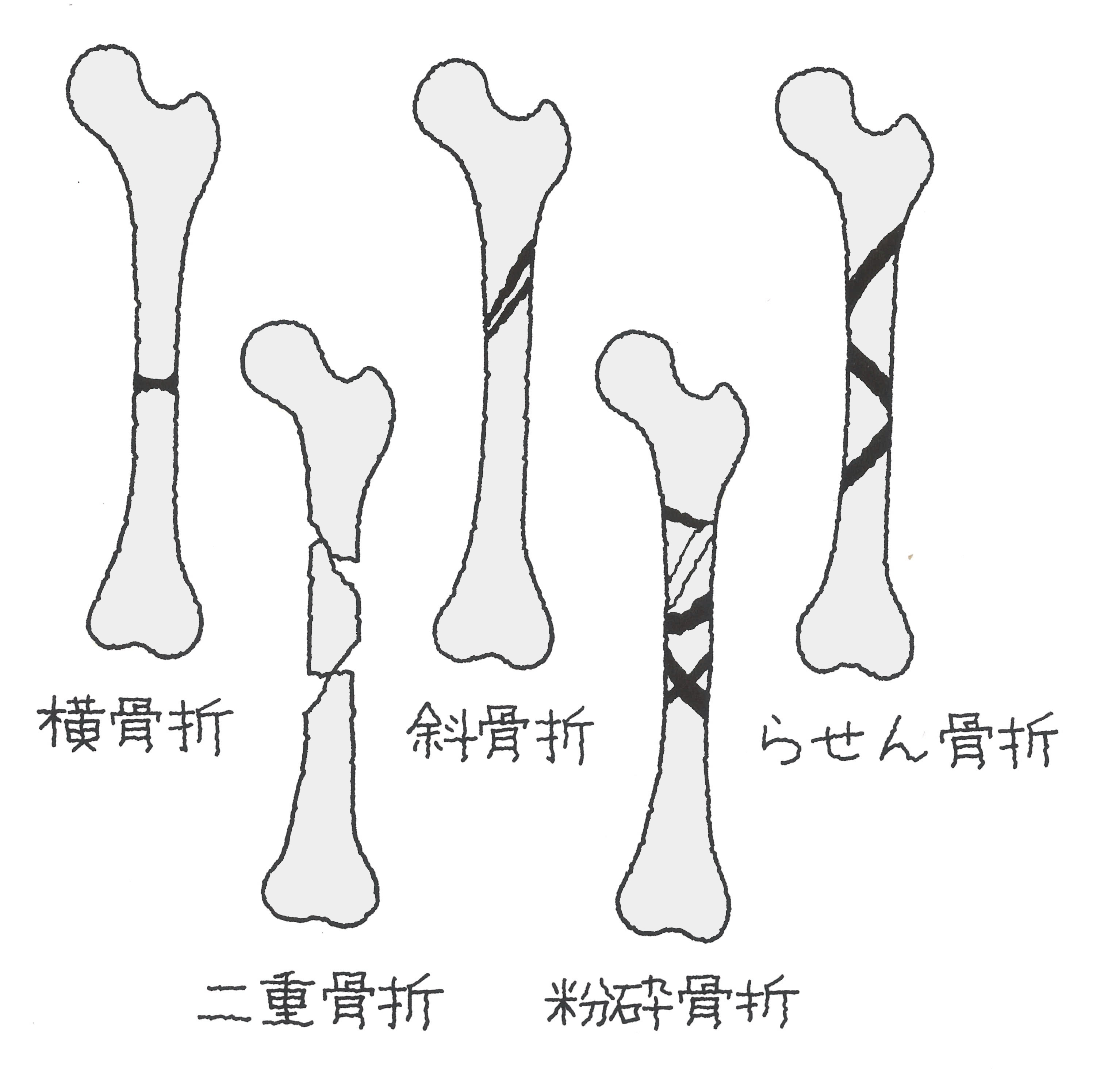 ヒビ と 骨折 の 違い