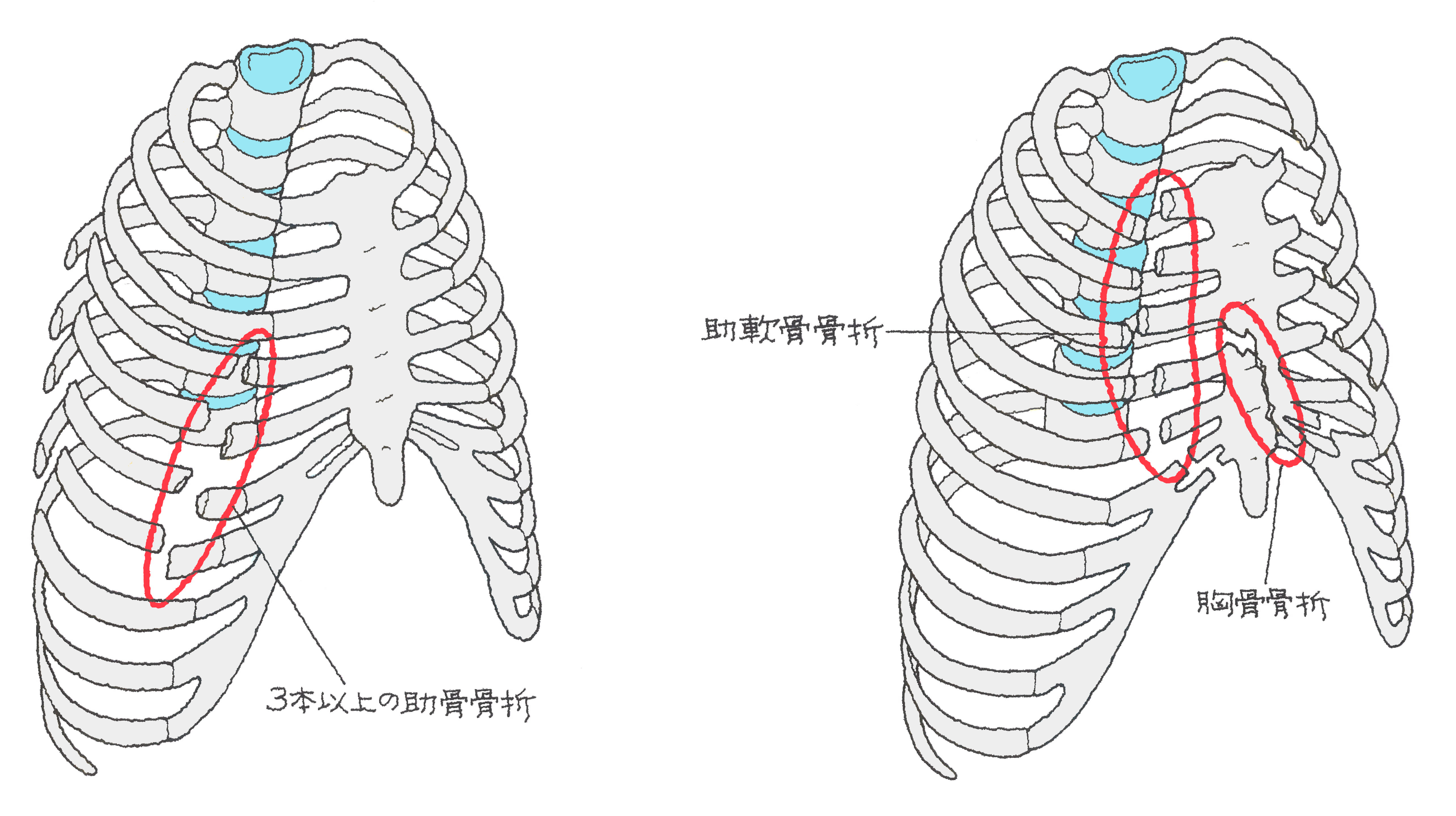 骨折 リハビリ 肋骨 CiNii Articles