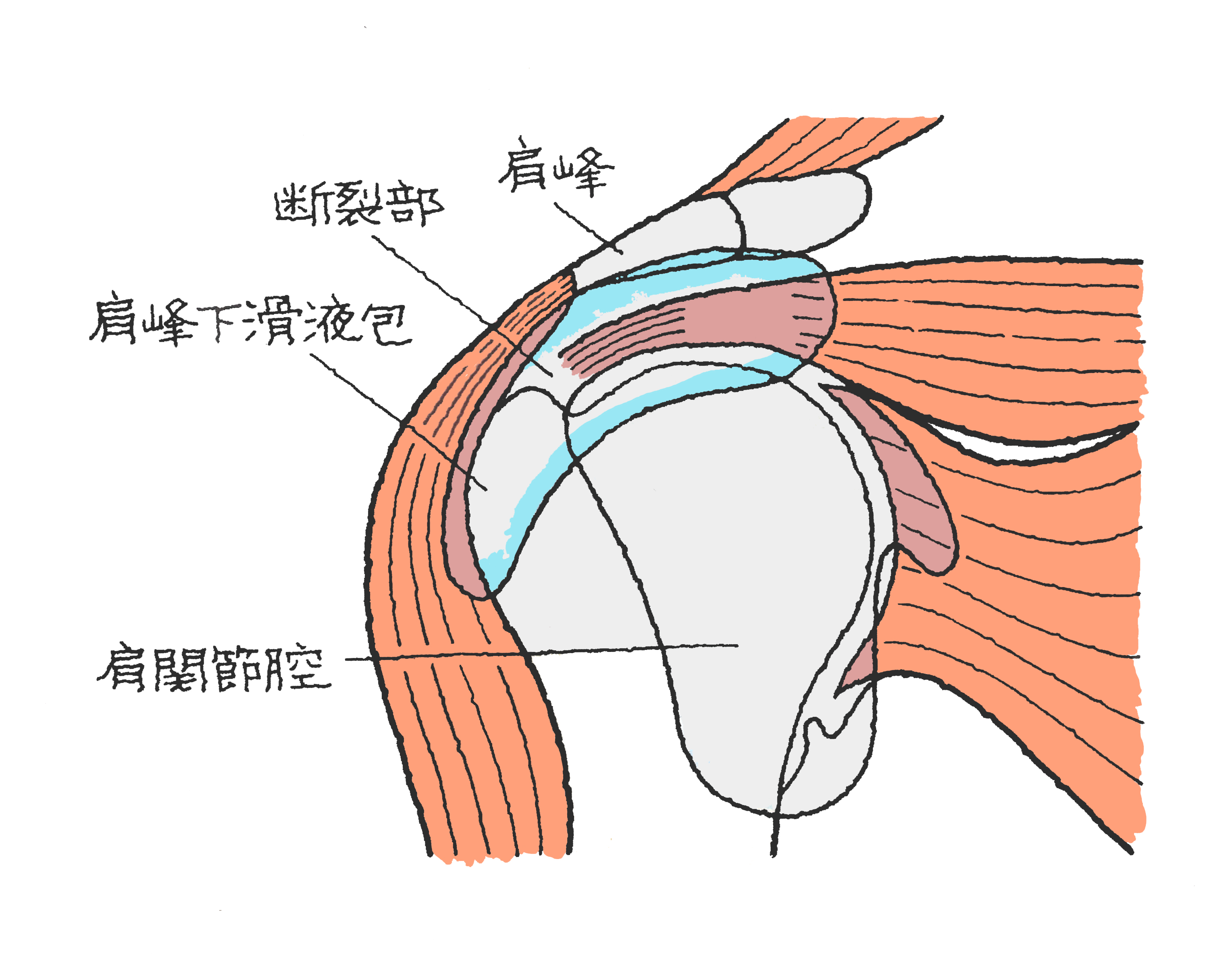 肩 腱 板 断裂 の 等級 は いくら