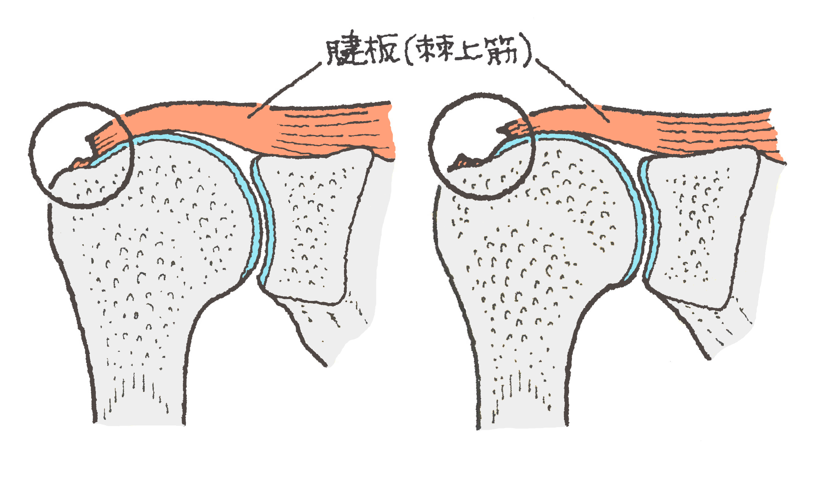 腱板断裂