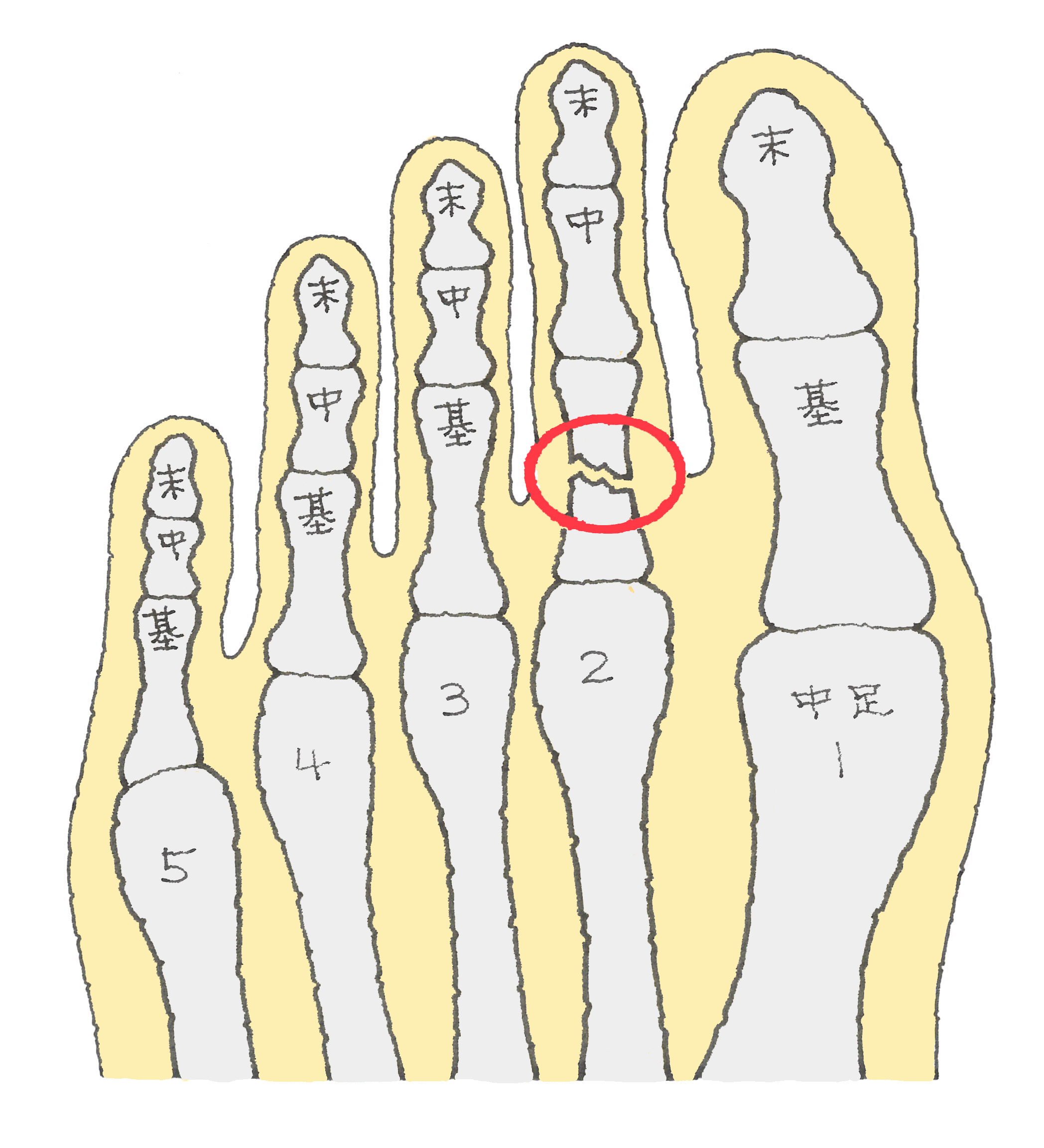 骨折 足 親指 足趾の骨折 種子骨の骨折（しゅしこつのこっせつ）