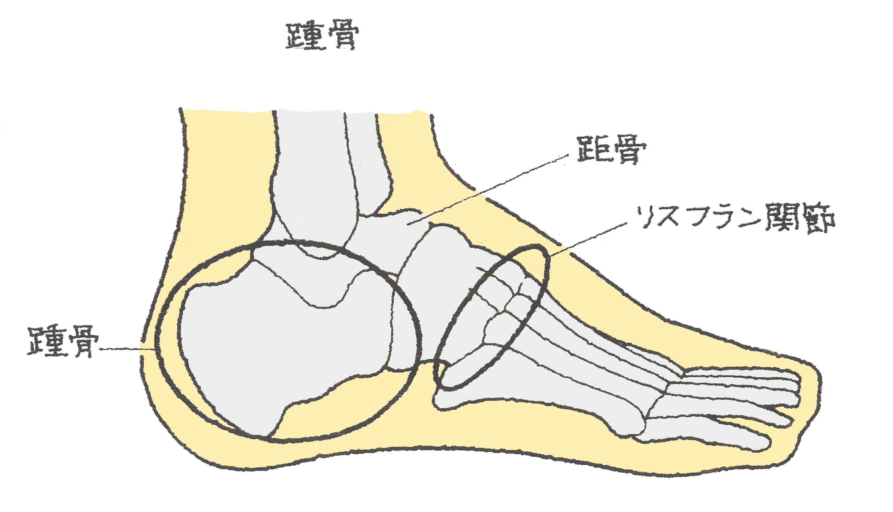 足根骨の骨折 リスフラン関節脱臼骨折そっこんこつのこっせつ りす