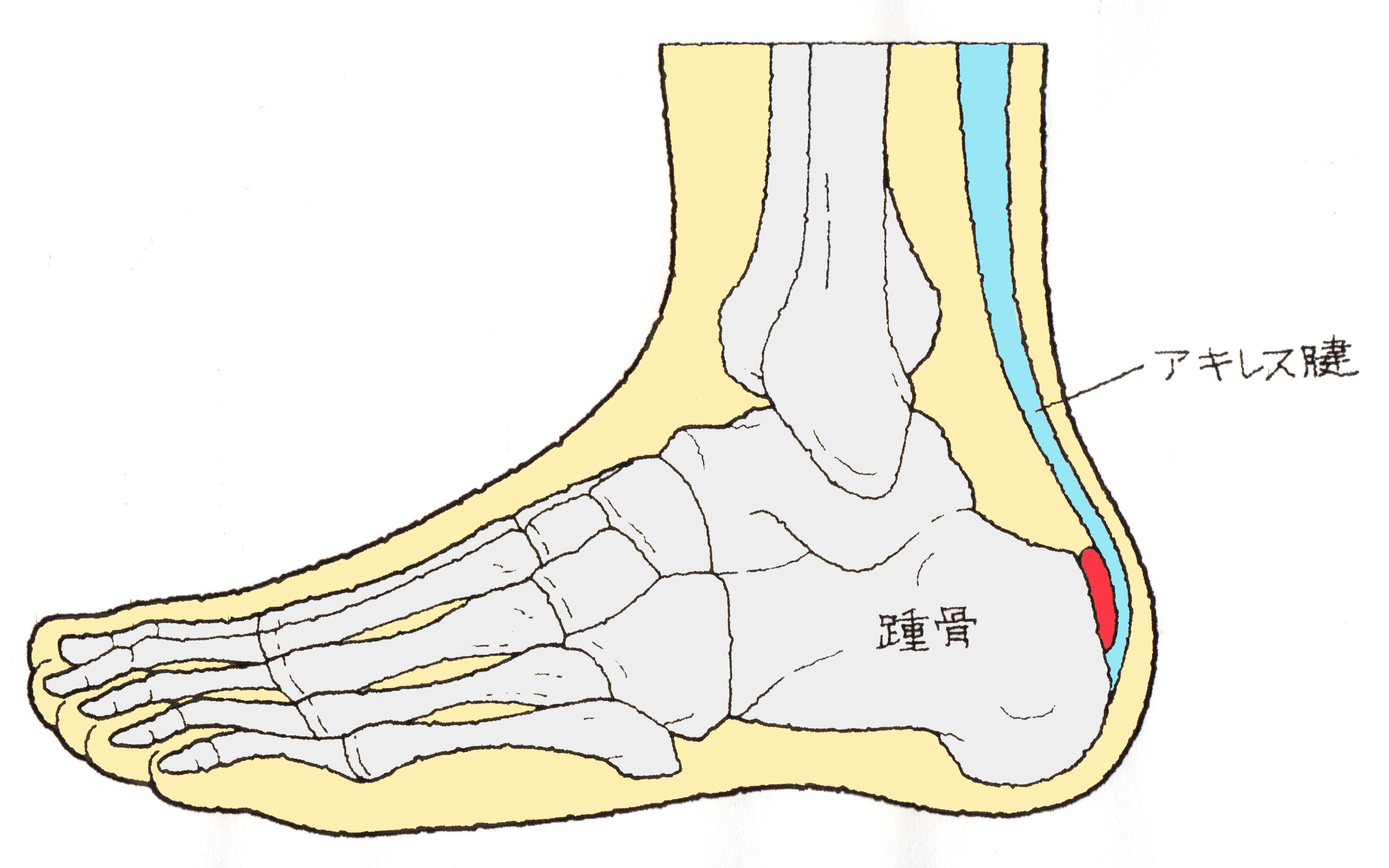 アキレス腱 の 滑 液 包 炎