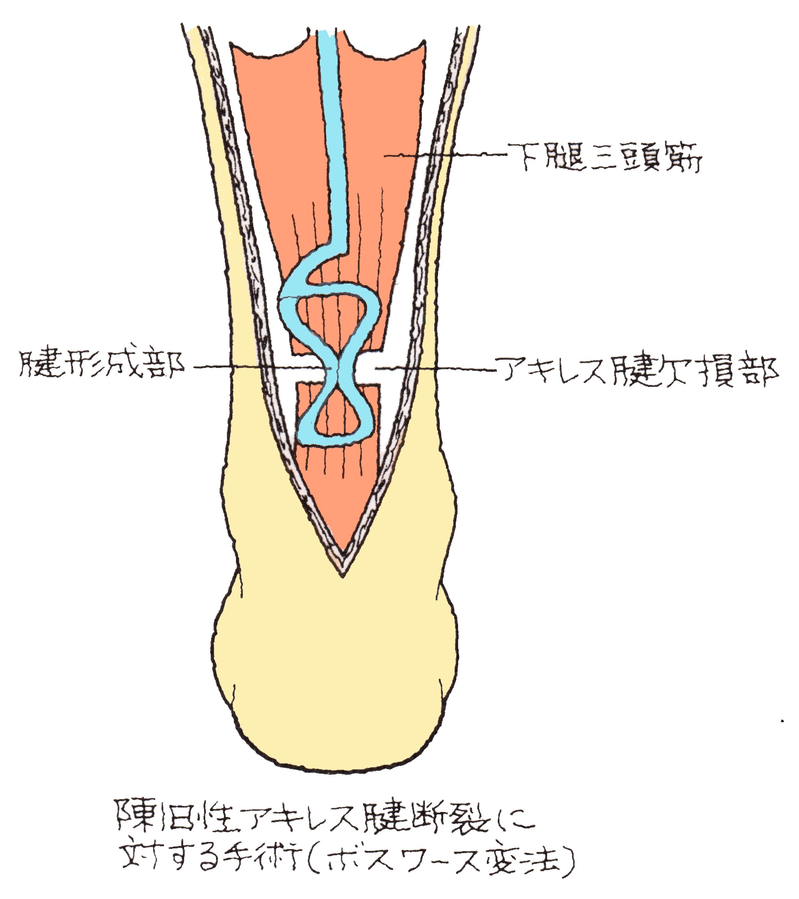 屈筋腱断裂に対する腱の癒合と腱縫合術について ｜ XPERT