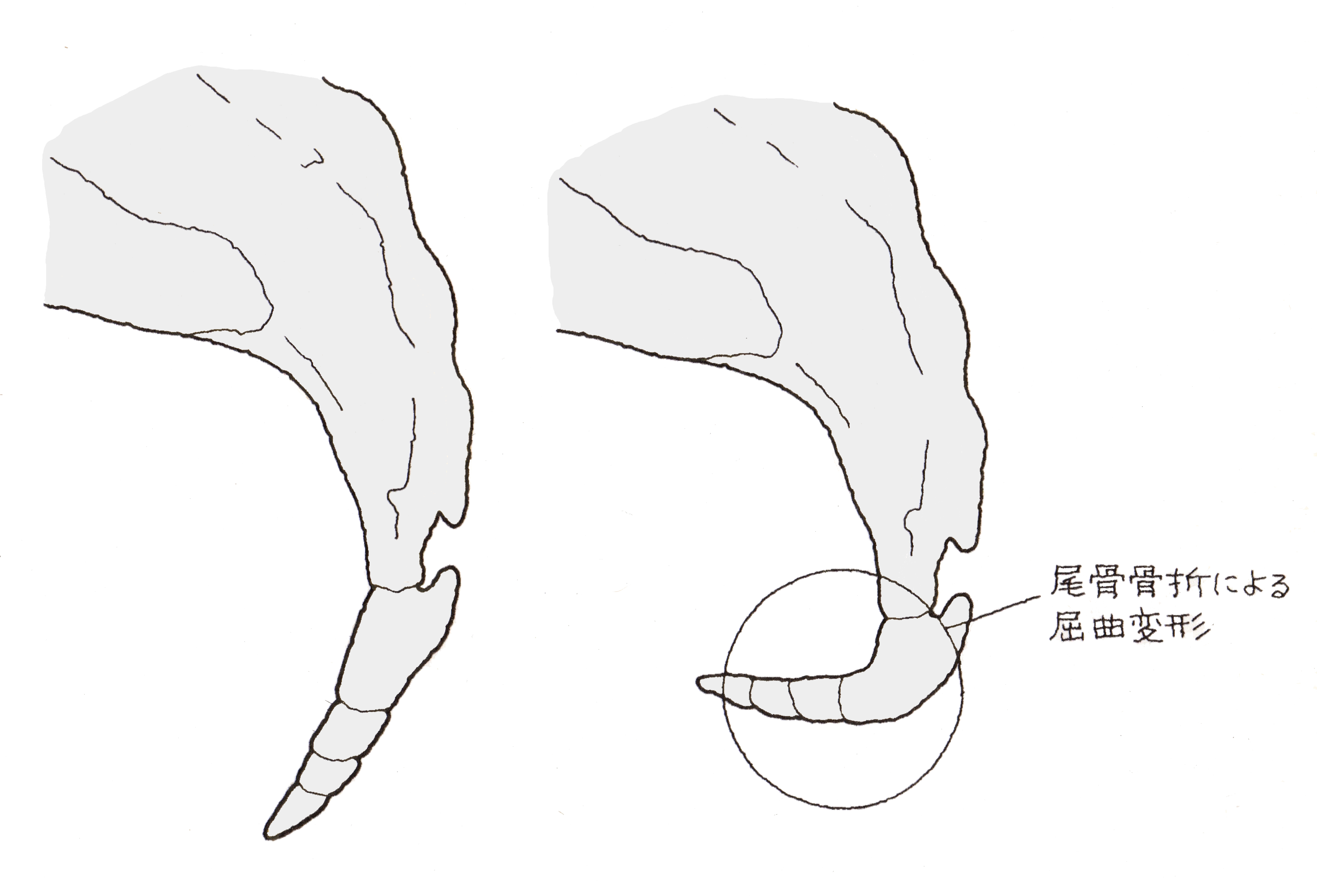 尾てい骨 に ヒビ