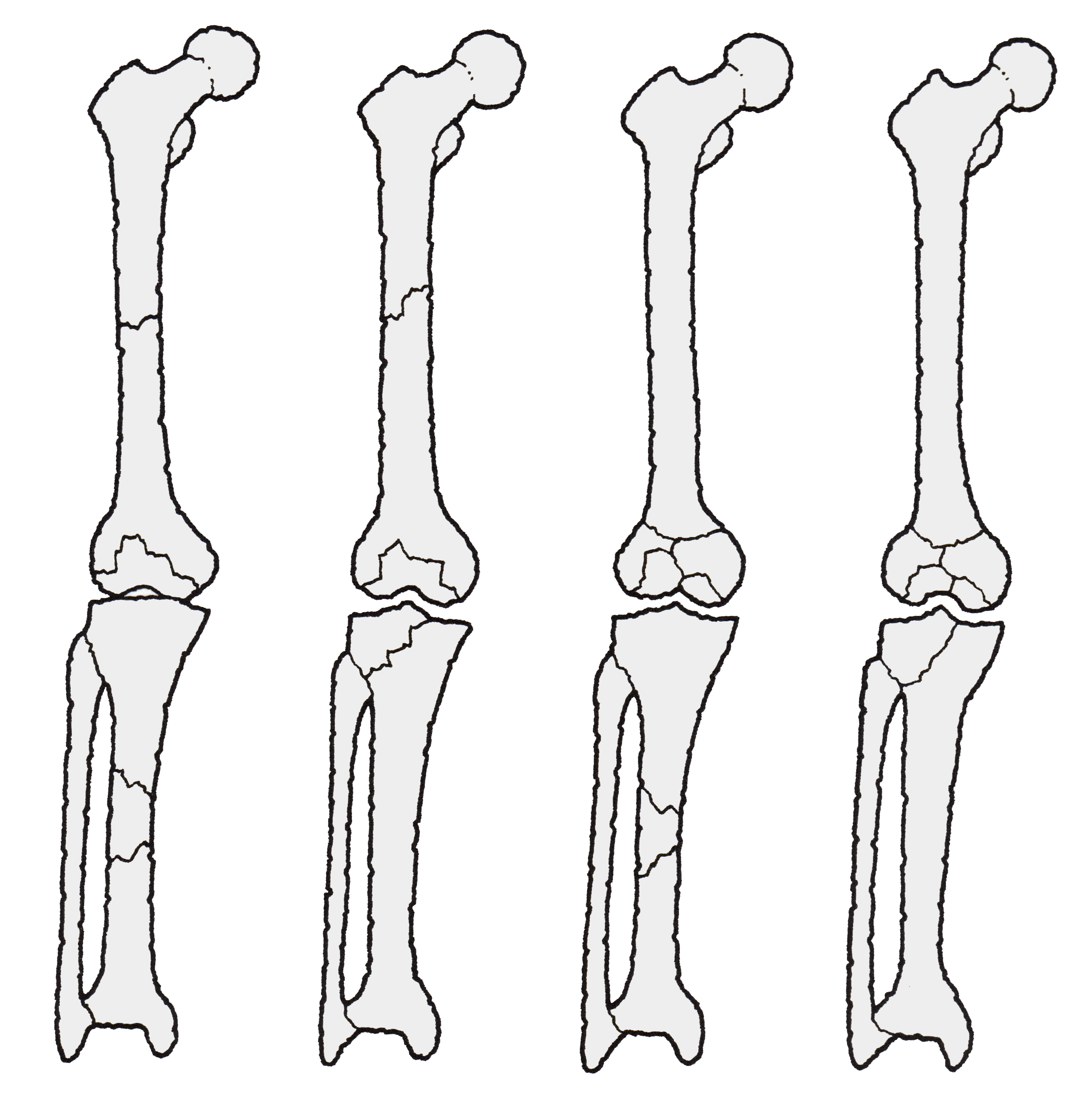 メタノート別館: 大腿骨頚部骨折の治療