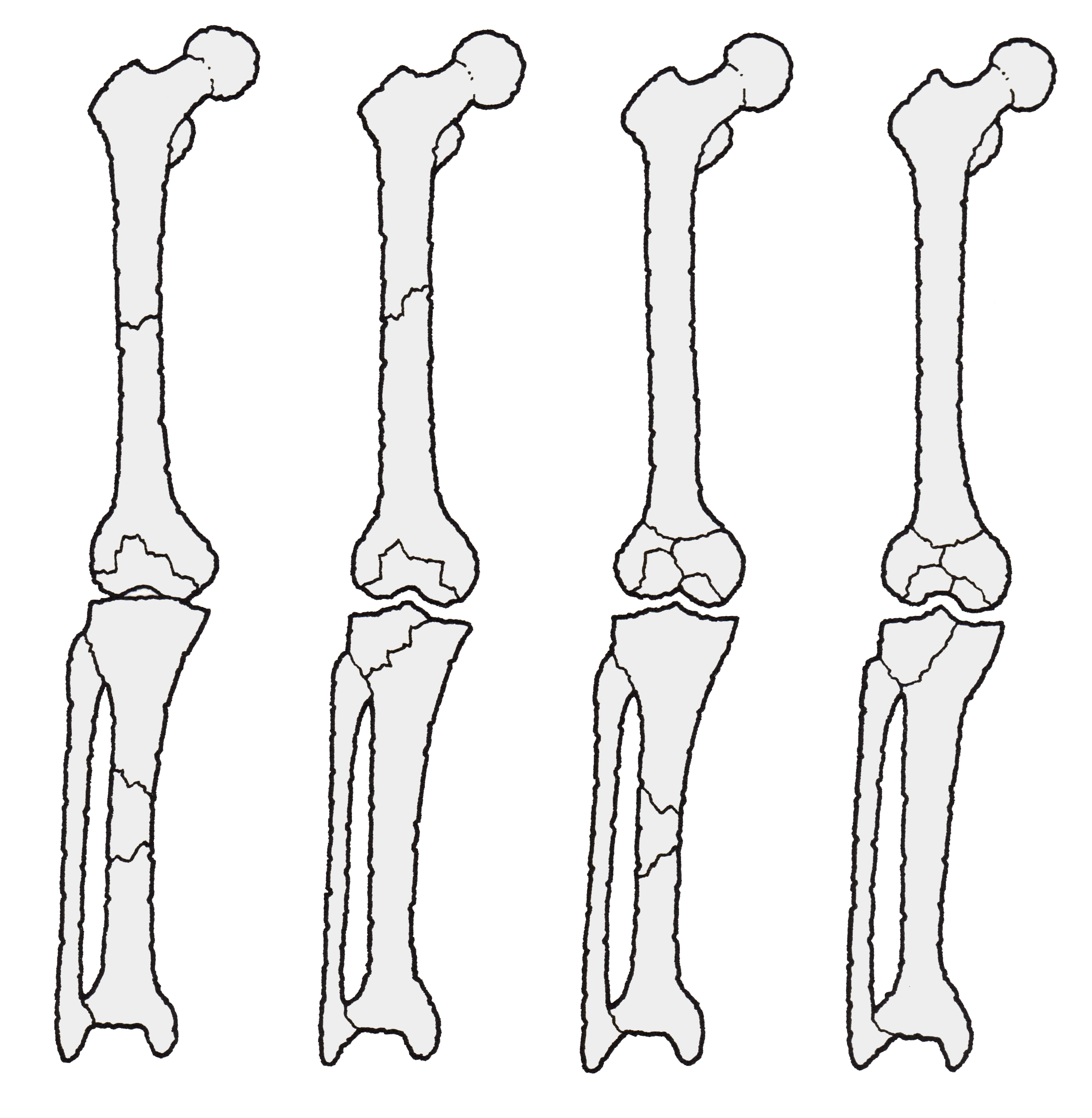 大腿骨転子部骨折の手術とリハビリの進め方。注意点についても解説 - かずぼーのリハビリ大全