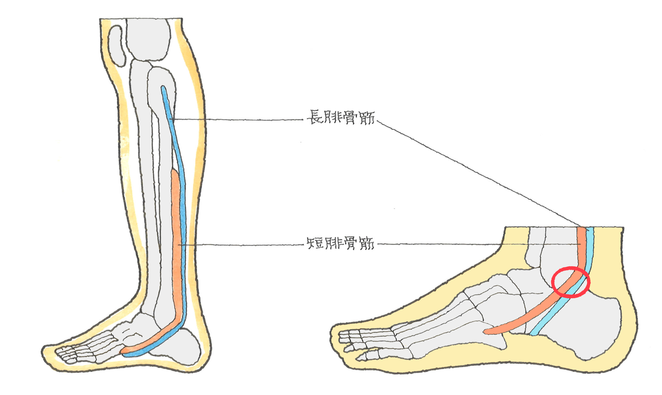 腓骨筋腱炎