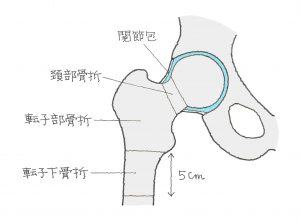 骨折 子 骨 大腿 転 部