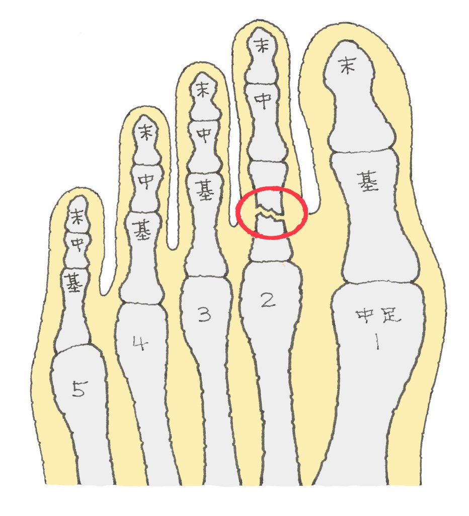 足指骨折見分け方