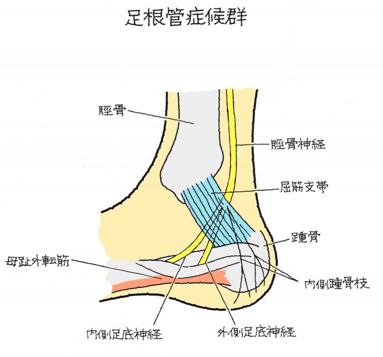 足根骨の骨折 足根管症候群（そっこんかんしょうこうぐん） 福岡の弁護士による後遺障害・等級認定サポート