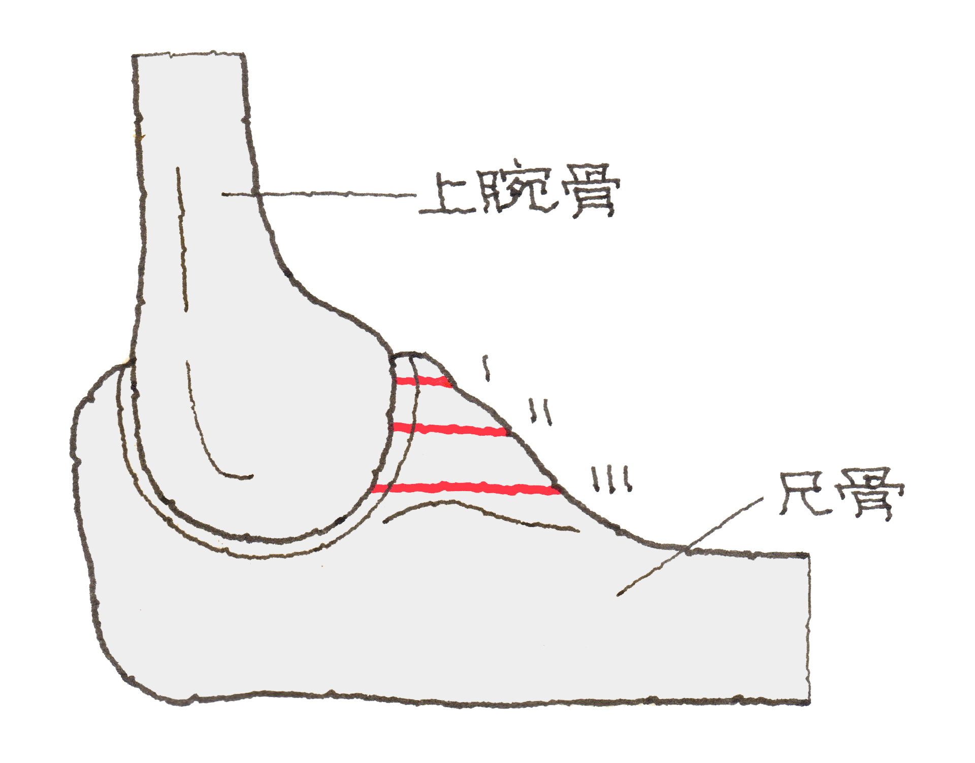 尺骨鉤状突起骨折 しゃくこつこうじょうとっきこっせつ 福岡の弁護士による後遺障害 等級認定サポート