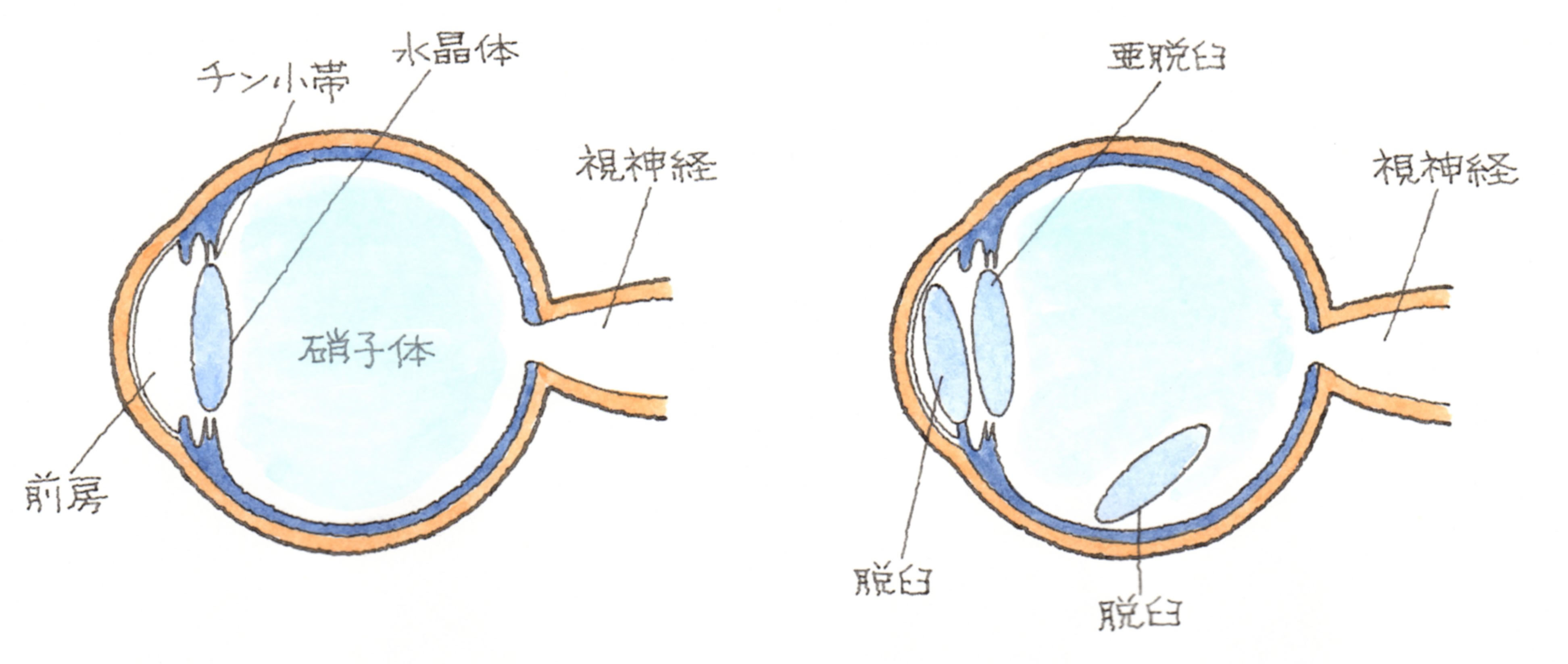 水晶体亜脱臼 （すいしょうたいあだっきゅう） | 福岡の弁護士による